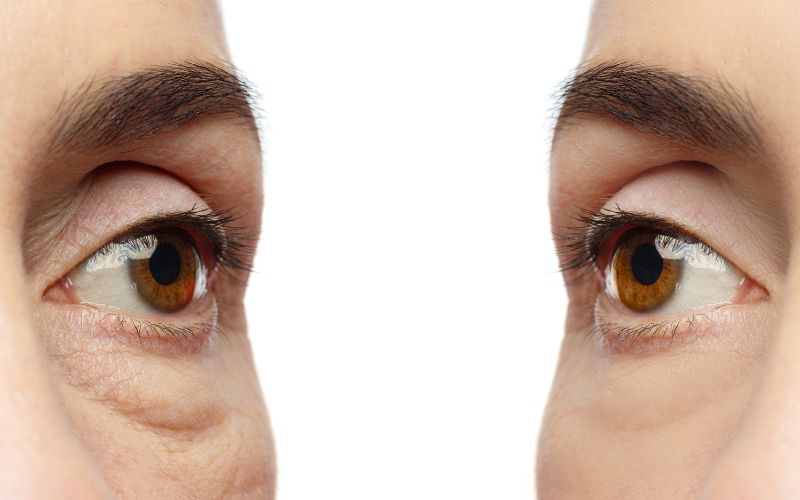 Có nhiều nguyên nhân khách quan và chủ quan làm lão hóa da vùng mắt