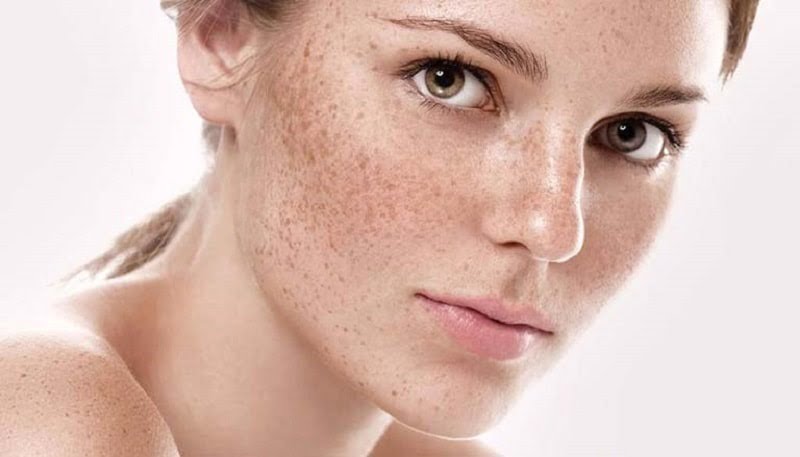 Tăng sắc tố melanin làm nổi những mảng nám, đốm đen trên khắp vùng da mặt
