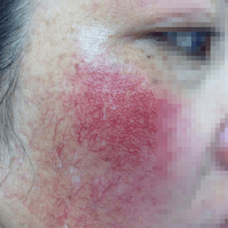 Hình ảnh làn da bị nhiễm Corticoid nghiêm trọng khiến da hiện rõ nhiều mạch máu