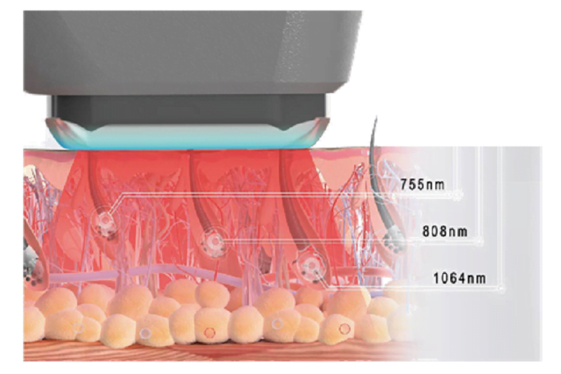 Công nghệ Diode Laser sử dụng 3 bước sóng ngắn để triệt lông