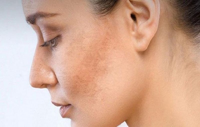 Một số bệnh về da nguyên hiểm có thể dẫn đến tình trạng sạm da ở phụ nữ