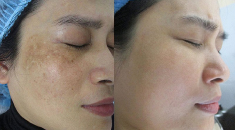 Bắn laser trị nám bao lâu thì hết - 2