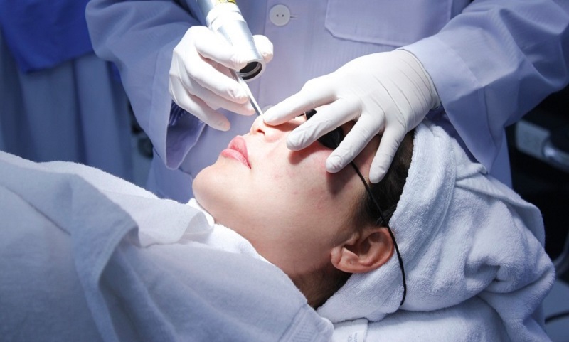 Bắn laser trị nám bao lâu thì hết - 3