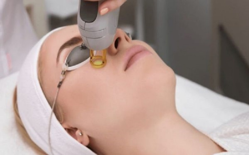 Bắn laser trị nám bao lâu thì hết - 5