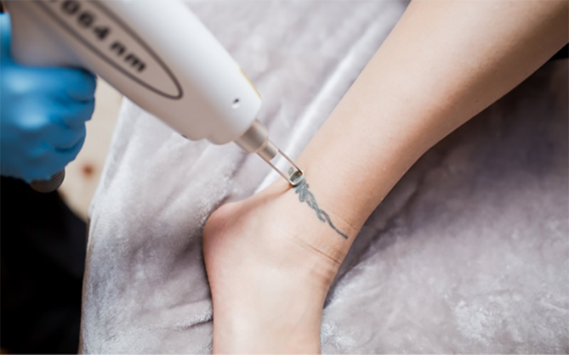 Máy xóa xăm mini có thể sử dụng cho cả tay, chân, viền môi