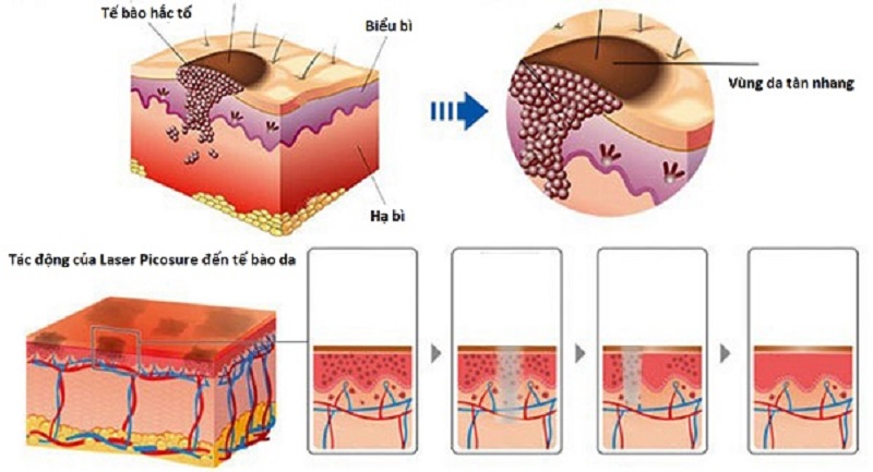 Công nghệ trị nám Picosure - 2