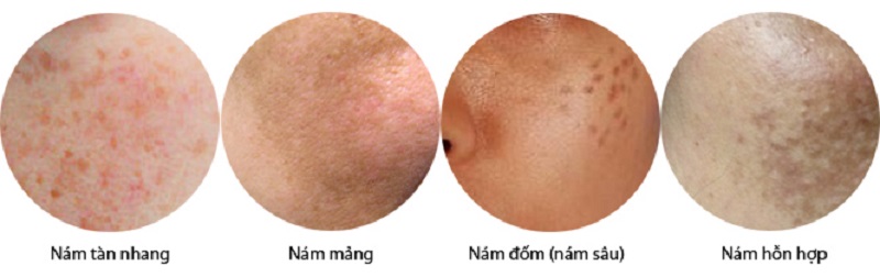 Công nghệ trị nám Picosure - 3