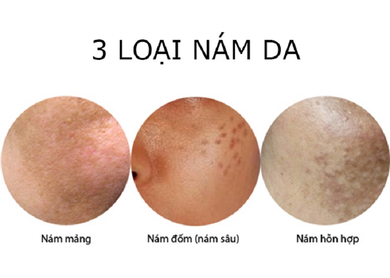 Công nghệ trị nám tốt nhất hiện nay - 1
