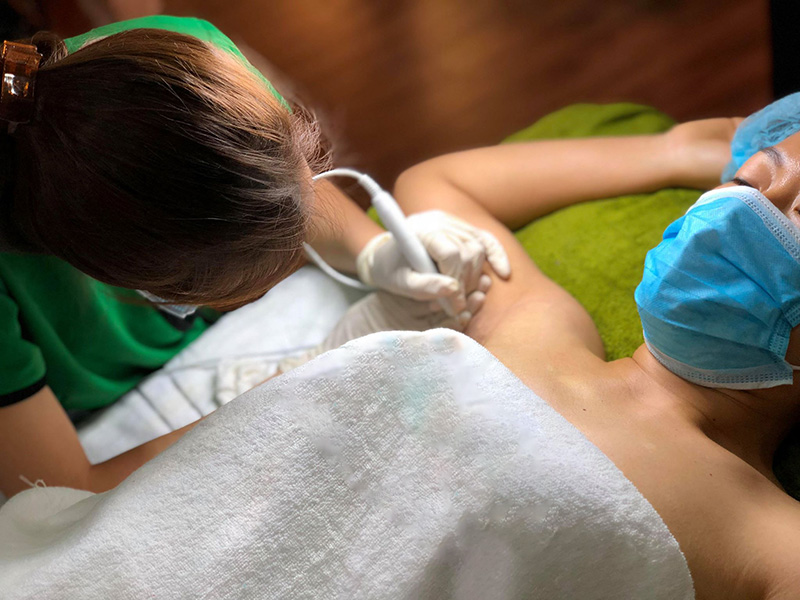 Điều trị hôi nách bằng Laser Plasma rất an toàn