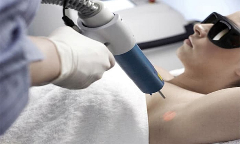 Liệu trình triệt hôi nách Laser Plasma không quá cao