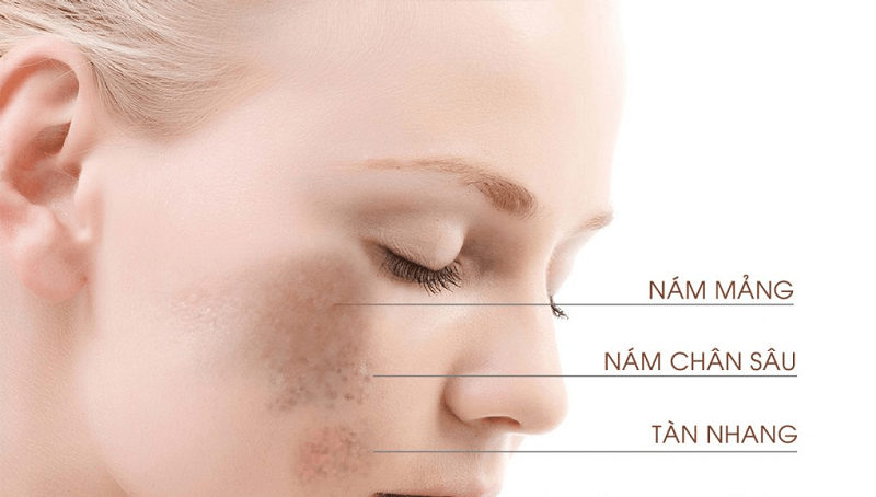 Máy laser trị nám tốt nhất hiện nay - 1