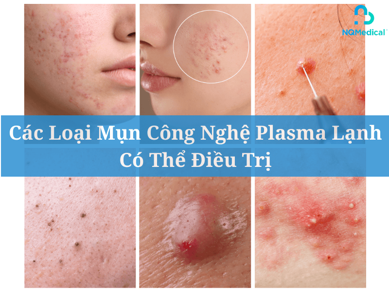 Plasma lạnh trị mụn 9