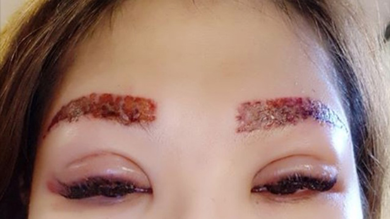 Xóa lông mày bị đỏ không khó chỉ cần bạn áp dụng đúng cách