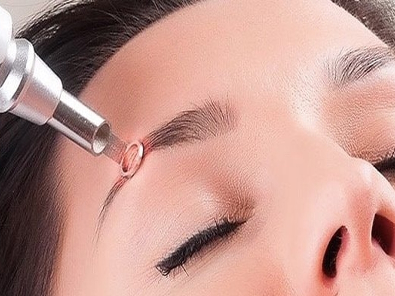 Xóa xăm lông mày có hết hoàn toàn không - 4
