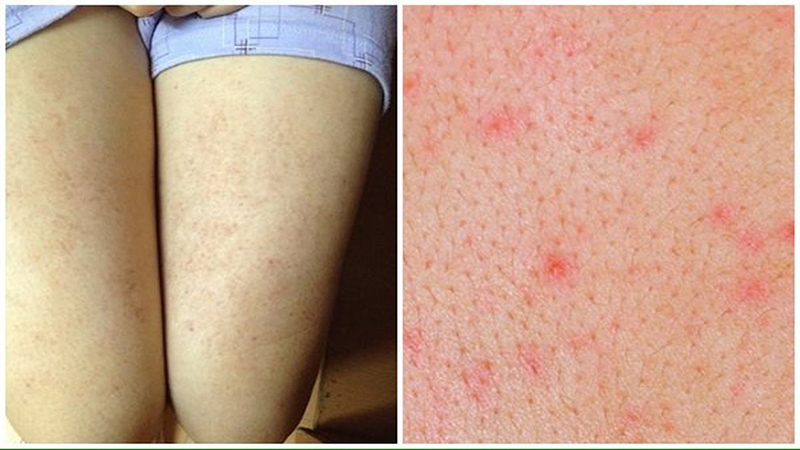 Da dị ứng không nên tẩy lông chân