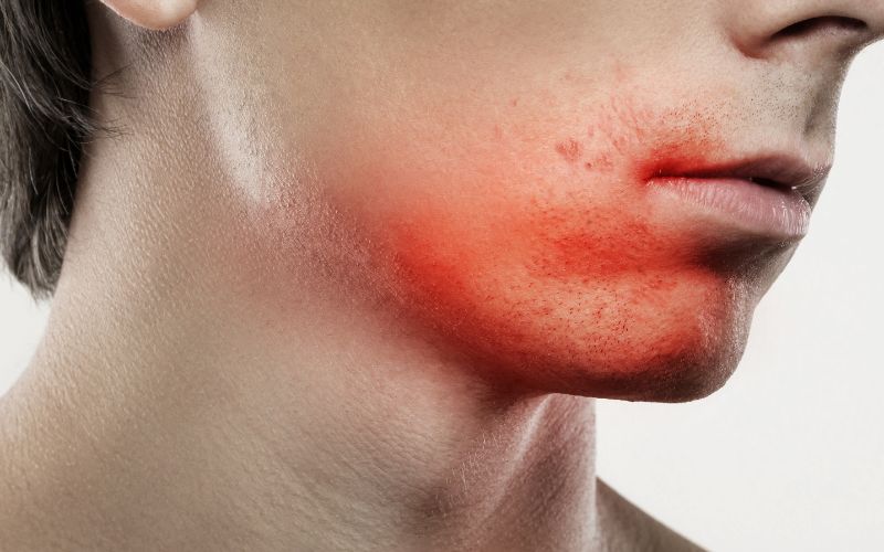 Cạo lông mặt sai cách khiến da bị kích ứng và tổn thương