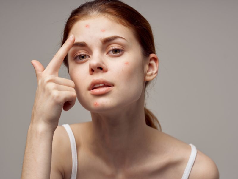 Da mụn tuyệt đối không nên tự ý cạo lông mặt tại nhà