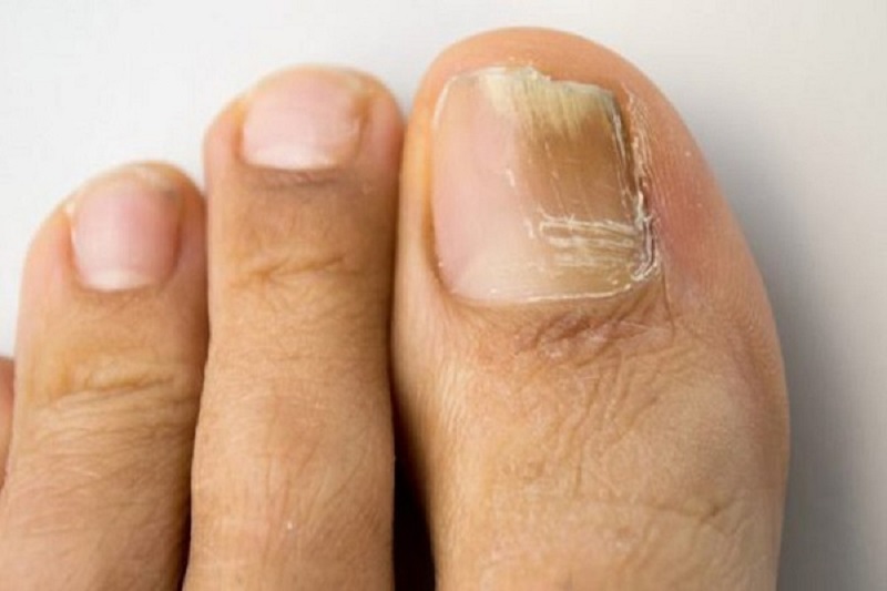 cách dưỡng móng chân bị hư 1