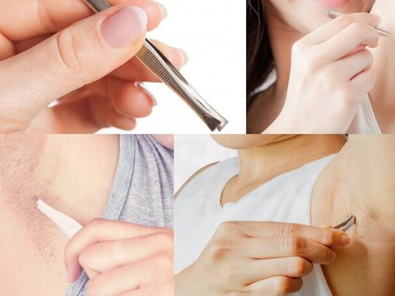 Gắp sợi lông mọc ngược nhẹ nhàng