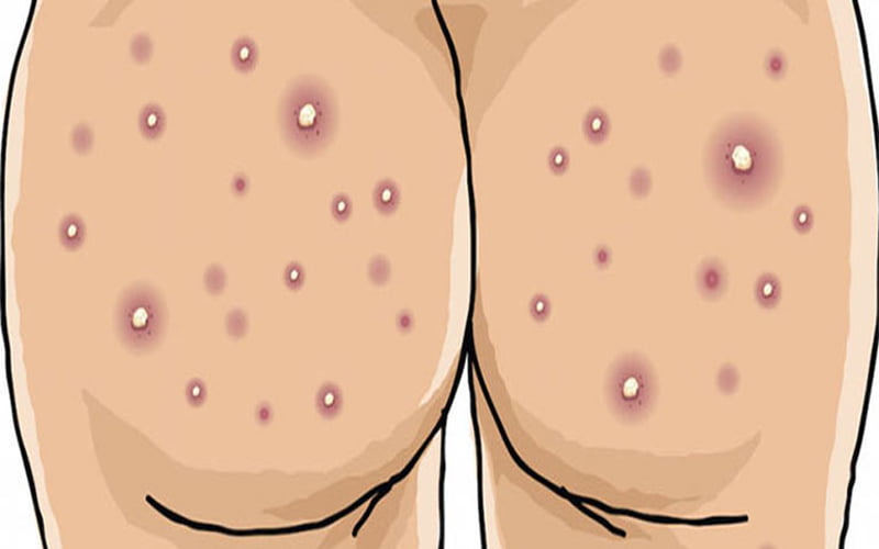 Mụn nhọt xuất hiện ở mông bởi nhiều nguyên nhân khác nhau