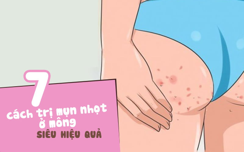 Bạn có thể tham khảo các cách trị mụn nhọt ở mông bên dưới
