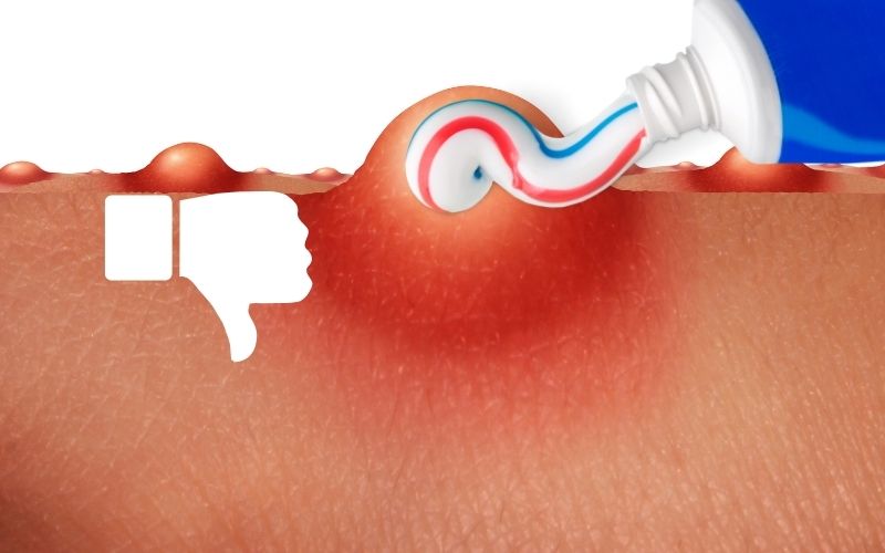 Kem đánh răng khi thoa lên mụn có thể làm dịu nhanh chóng