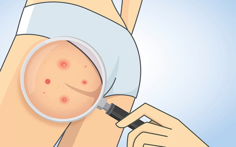 Tùy vào mức độ nghiêm trọng mà mụn có thể hết sau vài ngày hoặc vài tuần