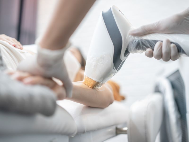 Triệt lông bằng laser đang được áp dụng phổ biến tại các spa thẩm mỹ ở Việt Nam