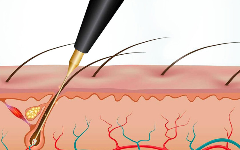 Cơ chế hoạt động chuyên sâu của công nghệ IPL