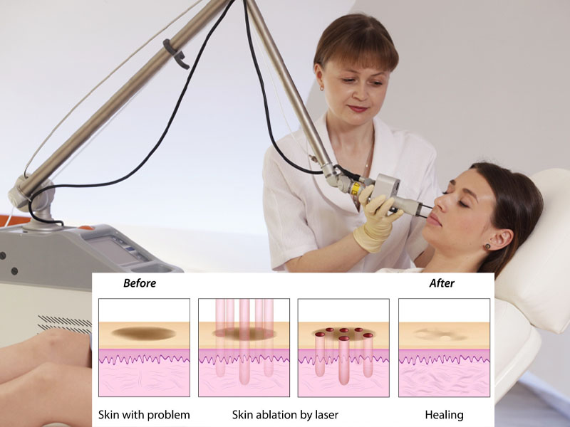 Điều trị sẹo bằng công nghệ Laser Fractional Co2