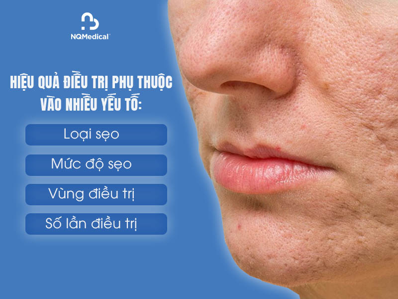 Điều trị sẹo bằng công nghệ Laser Fractional Co2