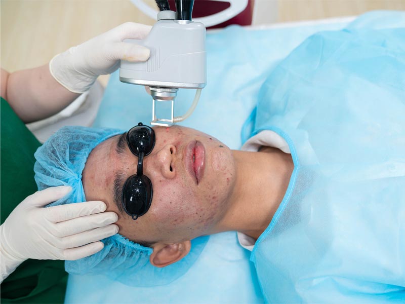điều trị sẹo rỗ bằng laser fractional co2