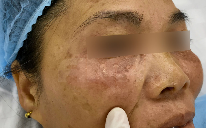 Laser Fractional CO2 5