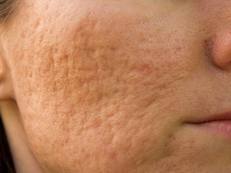 laser fractional co2 trị sẹo lõm 3