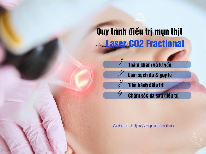 laser fractional co2 trị sẹo lõm 5