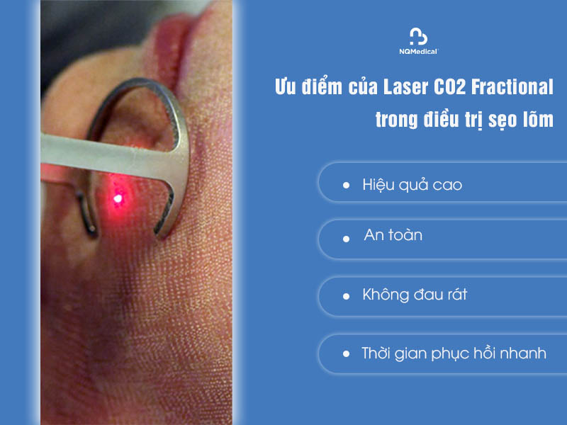 laser fractional co2 trị sẹo lõm 4