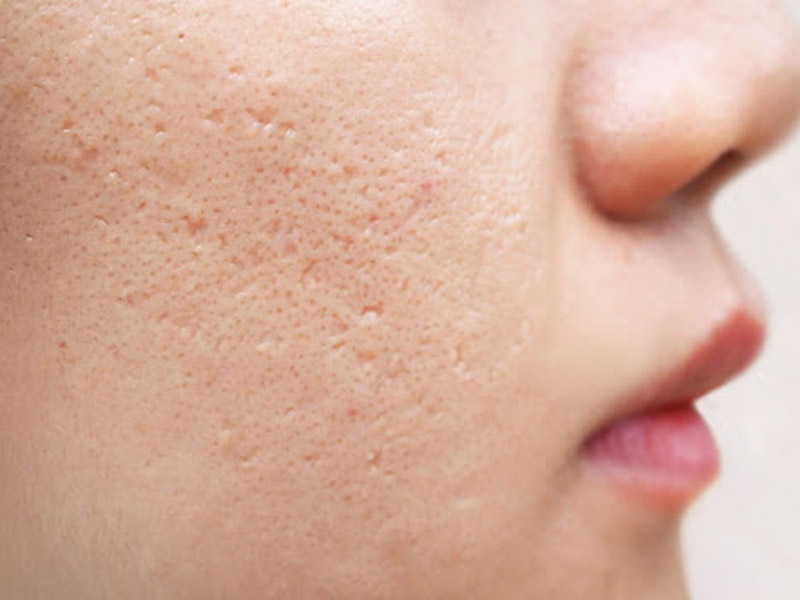 laser fractional co2 trị sẹo lõm 6