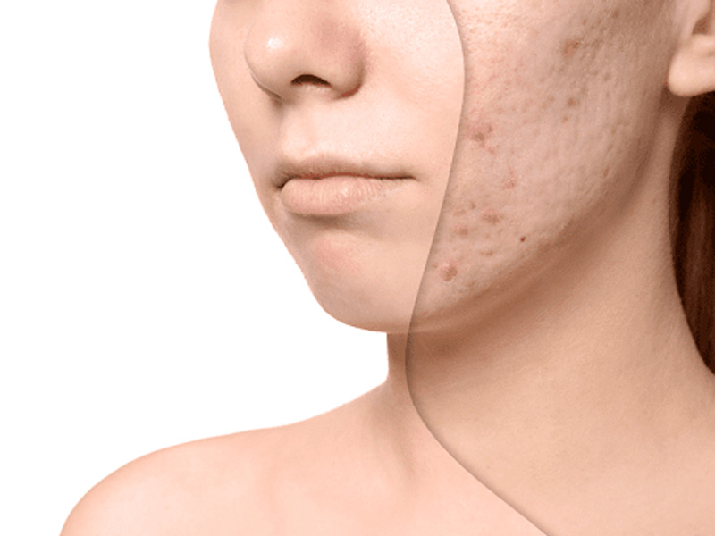 laser fractional co2 trị sẹo lõm 8