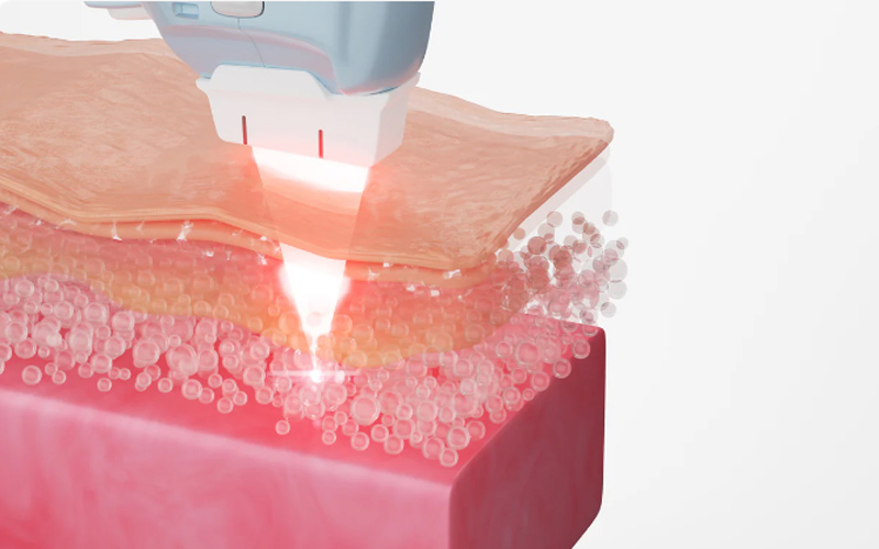 Laser là gì 3
