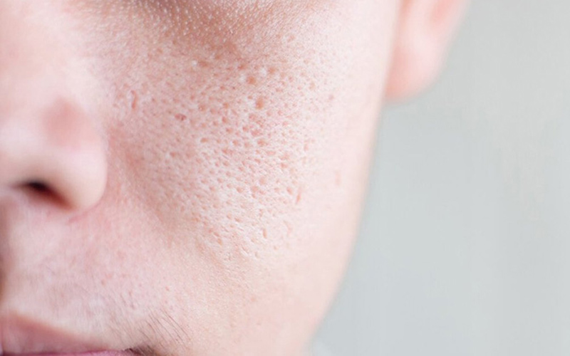 Se khít lỗ chân lông bằng Laser CO2 Fractional 1