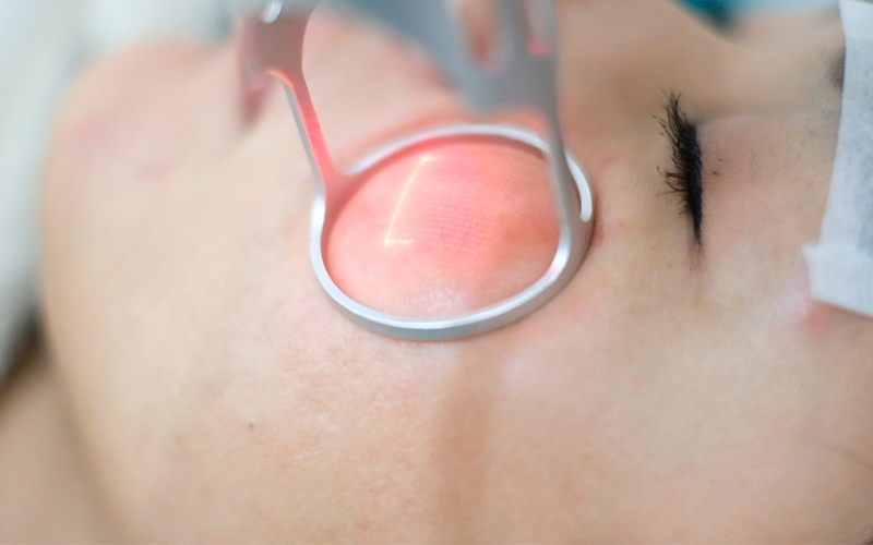 Se khít lỗ chân lông bằng Laser CO2 Fractional 2