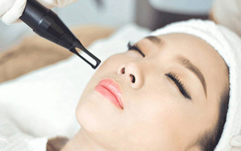 Se khít lỗ chân lông bằng Laser CO2 Fractional 3