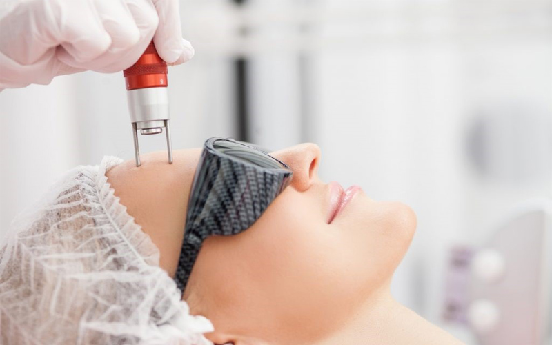 Trẻ hóa da bằng Laser CO2 Fractional 5