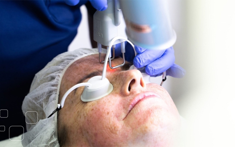 Trị mụn bằng Laser CO2 Fractional 1