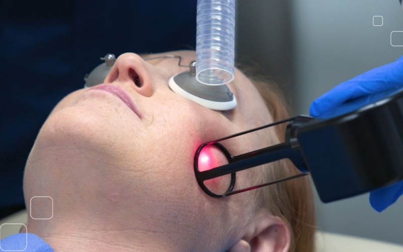 Trị mụn bằng Laser CO2 Fractional 2