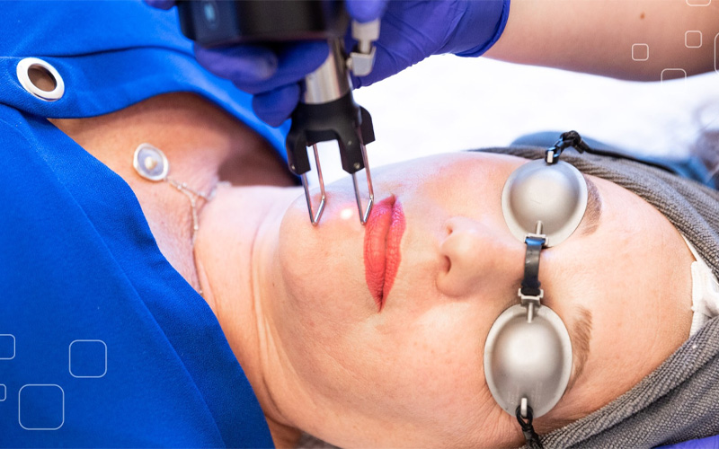 Trị mụn bằng Laser CO2 Fractional 3