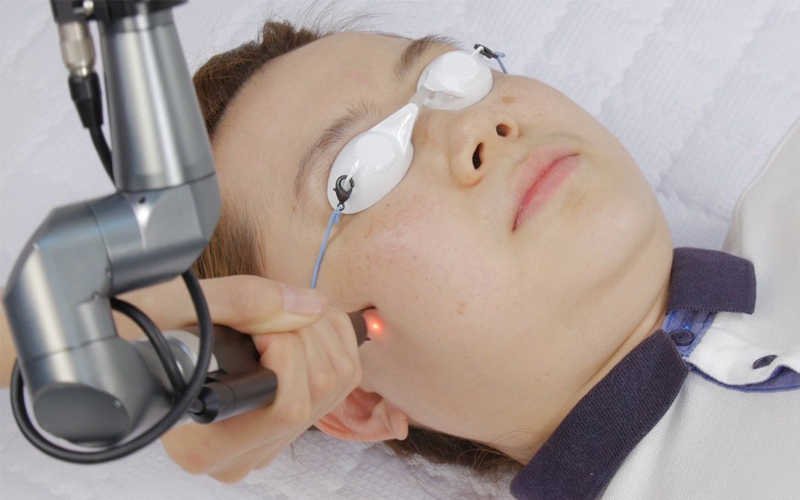 Trị mụn bằng Laser CO2 Fractional 4