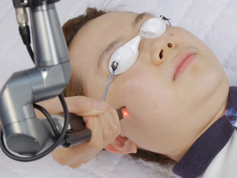 Trị mụn thịt bằng Laser CO2 Fractional