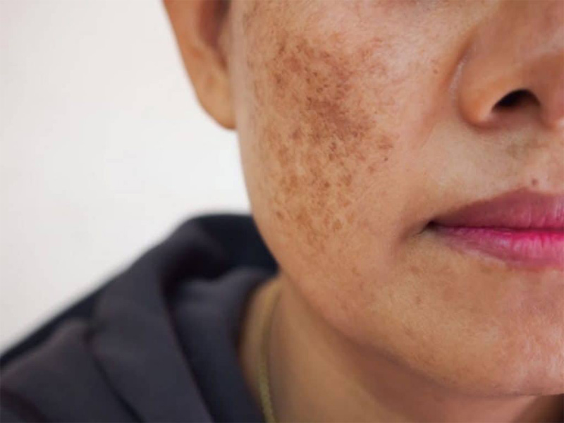 Trị mụn thịt bằng Laser CO2 Fractional