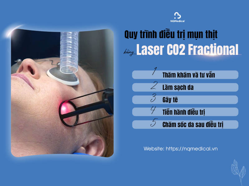 Trị mụn thịt bằng Laser CO2 Fractional